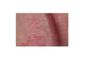 Red rash on penis
